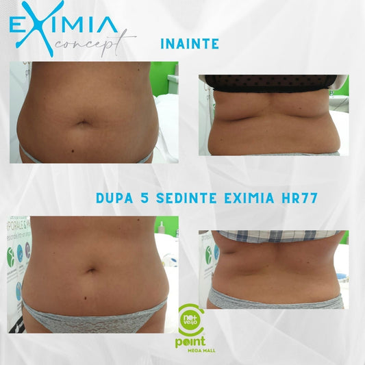 Eximia HR77 pentru abdomen in Bucuresti — cum functioneaza, preturi si ce sa stii inainte